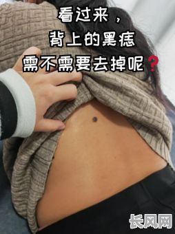 背心长肉痣究竟是什么命格？预示着怎样的命运？