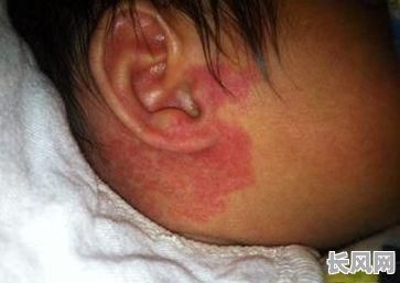 后脑勺的红色胎记算命，这究竟预示着什么命运？