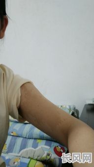 棕色胎记究竟代表着怎样的命格？它预示着什么样的命运？